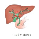 클라츠킨 종양(Klatskin`s tumor) 이미지