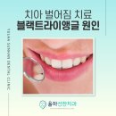 율하프라임치과의원 | 진해 치과, 치아 벌어짐 치료· 블랙트라이앵글 원인은?