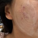 금강한의원 | 강남 역삼 여드름패인흉터치료 피부과, 새살침 2회차 후기