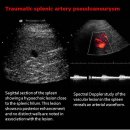 Traumatic splenic artery pseudoaneurysm 이미지