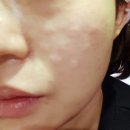 조이피부과의원 | 여의도 유스피부과에서 아토스 모공레이저, AT 모공주사 맞고 아기피부 됐어요 ~