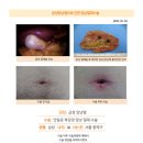 급성담낭염수술후기. 단일공 수술을 기존의 일반적인 복강경(2~3개의 incision)과 달리 배꼽에 단 한개의 incision만... 이미지