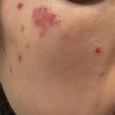 브라이트피부과의원 | 주말 일기 - 추석 연휴 앞두고 피부과 시술 받기(청담 르벨 의원)