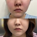 인모드 포마 Fx 풀페이스 후기 효과 통증