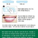 화이트치과 | [7일의 기적] 누런 이빨 탈출! 메디슨화이트 치아미백패치 셀프 사용 후기!! (치과 가기 전 필독)