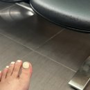 백두병원 | [백두병원] 엄지 발가락 골절 수술 후기
