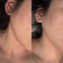 순환형1 | 대구 수성구 윤곽관리 팔뚝 림프순환 1회 효과 후기 핫탄스파
