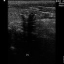 Thyroid papillary ca 이미지