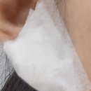 장미꽃과나이팅게일외과의원 | [수술 후기] 장미꽃과나이팅게일외과 피지낭종 급성 염증 당일 응급수술 후기 (주차 / 서류 / 경과 사진)