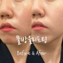 구로-구로-구로-159 | 구로피부관리 카에네에스테틱 물방울리프팅 후기