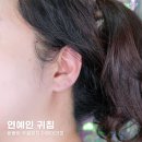 프롭테라피&밴드운동 | 요즘 난리 난 이혈테라피 주얼패치, 귀침으로 식욕억제까지?