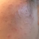 이화약국 | 약국 폼클렌징 추천 동아제약 애크온 딥 클렌징 폼 내돈내산 좁쌀 여드름 찐후기