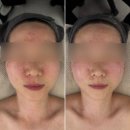 움트 - 서초구 | 신부관리 마곡웨딩관리 마곡윤곽관리 • 움트다에스테틱 맞춤조각 리프팅 후기 예신관리추천 신부관리추천