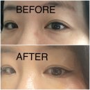 예뻐질걸 | 비수술 눈밑지방재배치 레이저 강남피부과 솔직 후기: 멍/붓기 없는 눈밑 시술 효과와 피부 재생