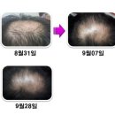 늘푸른의원 | 대전 늘푸른의원 탈모 치료, 탈모샴푸 그래비티로 건강한 모발을 되찾자!