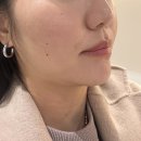 600 | 신사 올타이트리프팅 600샷 후기 | 리프팅 전후 비교(팔자주름∙이중턱∙심부볼 개선)