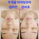 에바다체험케어 | 양악 수술만이 답인 줄 알았어요... 뼈 자체 발달 비대칭, 두골비로 기적을 만나다 (20회차 리얼 후기)