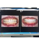 밸런스치과병원 | 판교 무삭제 라미네이트 후기｜밸런스치과병원 내돈내산 리얼 변화