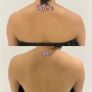 하이퍼들 | 창원 웨딩관리 제뉴인에스테틱 하이퍼소닉으로 뭉친 승모근 뿌신 후기