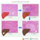 A형간염, B형간염, C형간염, E형간염[오늘의 간염, 내일의 간암] 이미지