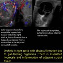Orchitis with abscess formation and hydrocele 이미지
