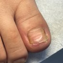 엔피(NP)케어 울산중구점 | 울산 내성발톱 참으면 안 됐어요