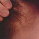 정희헤어라인 이미지