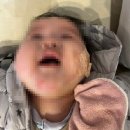 하늘반점 | [밀크반점 치료] 리멤버피부과 11회~15회차 치료 후기