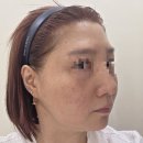 찐 | 강남역 리투오 스킨부스터 효과 내돈내산 찐 후기!
