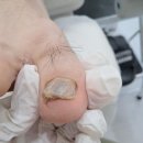 울산발톱무좀 위생적으로 관리 잘해주는 곳 하이푸스 울산수암점