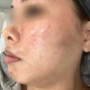 대전시청역피부관리 실펌엑스 내돈내산 후기:)