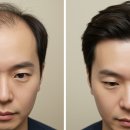 장기보령약국 | 로게인폼 약국 가격과 바르는 탈모약 효과 후기 – 솔직한 사용 경험과 정보 총정리