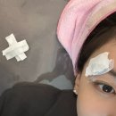 홍대흉터치료 여드름한의원으로 유명한 곳(새살침 1회 차 후기)