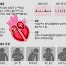 노인, 갑자기 숨차고 가슴 두근거리면 '심방세동:Atrial Fibrillation' 의심 이미지