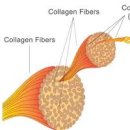선천성 콜라겐 결핍증 증상 원인 콜라겐 결핍증 치료 엘러스 단로스 증후군 이미지