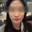 경산 성형외과 보톡스 시술 후기 (승모근보톡스/턱보톡스/이마미간주름보톡스)