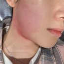 탑메디피부과의원 | 강남피부과 강남역 인모드FX 리프팅 일주일 후기