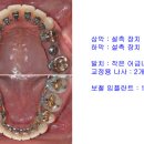 설측교정,돌출입교정,거미스마일 치료 교정 잘 하는 연치과의 "어금니 브릿지가 있는 돌출입 환자의 설측교정" 이미지