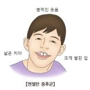 엔젤만 증후군[Angelman syndrome] 이미지