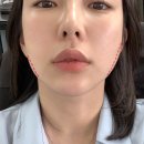 제이와이성형외과의원 네이버블로그