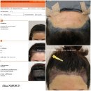 천성약국 | 부산 헤어라인 모발 이식 비절개 / 상담 + 수술 당일 + 암흑기 4달 경과 내돈내산 솔직후기