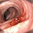 [건강이슈] mRNA 주사가 대장암 침윤을 부추긴다! 이미지