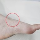 주식회사 엄지교육 | "엄지발가락에 감각이 없어요" 무용 입시생 김 OO...불편감 재활운동 실제 후기 ㅣ (주)아사힘 일산지점...