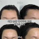 씨유 강남거평타운점 | 서울 강남 논현두피문신 헤어라인 교정 전문샵 살롱드예노! 정수리, 헤어라인 시술 후기