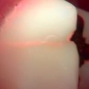 전주이든치과의원 | 전주 신경치료 치과 후기 | 자인치과의원 신경치료 및 크라운 치료