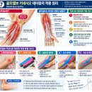 테니스엘보·골프엘보 테이핑 방법 팔꿈치 통증의 원인과 전완근 해부학. 이미지