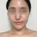 차오름 | 피부전문한의원 여드름흉터 치료 차오름침 후기