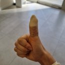 좋은아침외과의원 | 양배추채칼 채칼 손베임 손가락봉합 손가락꿰맴 후기