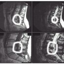 요추간판탈출증(허리디스크) 이미지