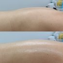 눈누샵 - 성남시 분당구 성남대로 34 | 안산피부관리 빛나는지금 안산점 눈누샵 방문후기(상체 등관리/바디라인 개선)